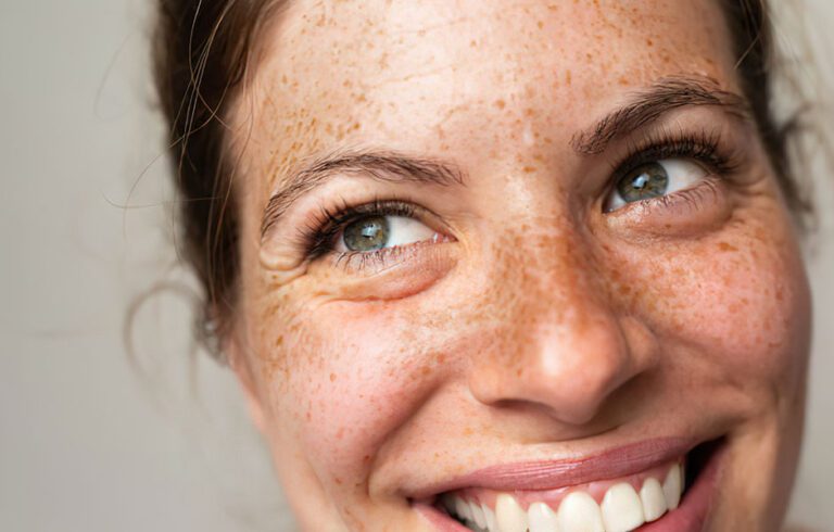 Lachende Frau mit Sommersprossen im Gesicht