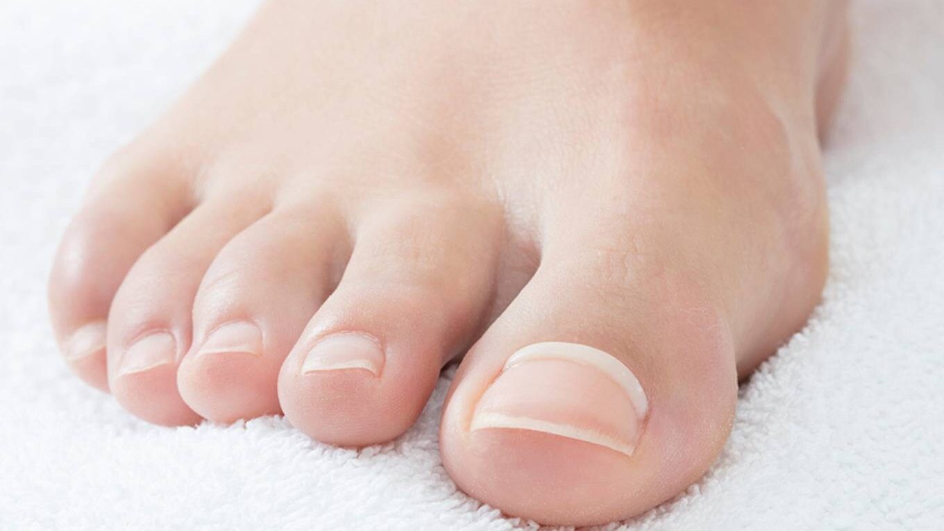 Großzeh mit Onyfix-Nagelspange: feines, durchsichtiges Band an der Nagelbasis
